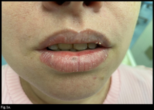  Multiple adherent white scales on both lips