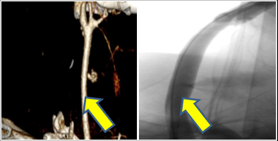 angiography