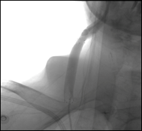 common carotid artery